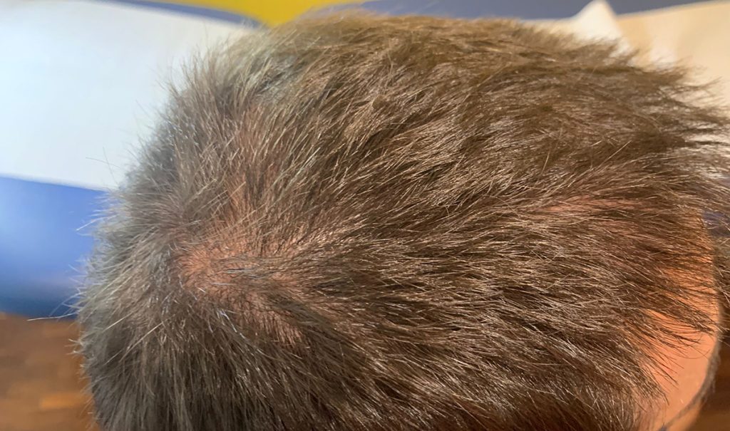 Carbossiterapia e mesoterapia per l'alopecia | Favola di Vita
